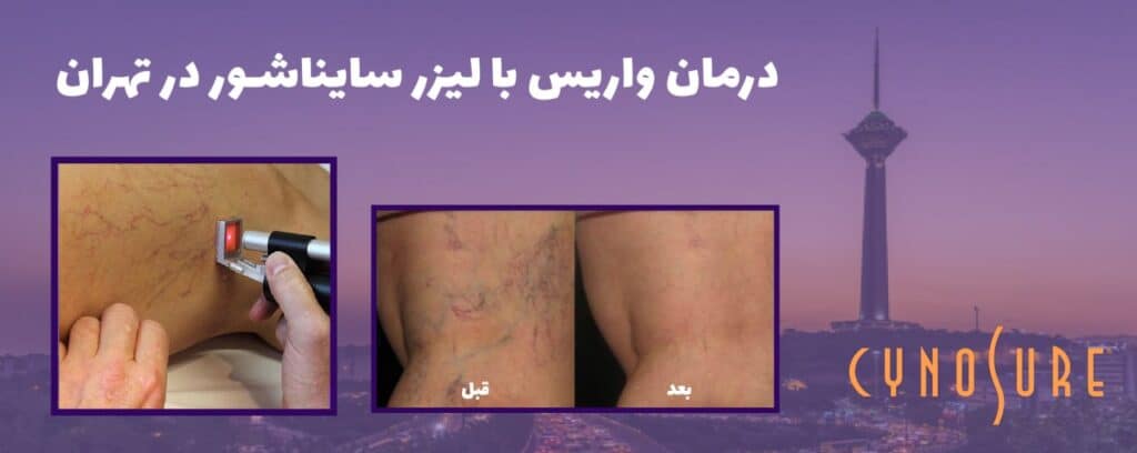لیزر سایناشور تهران سعادت آباد کلینیک پامچال