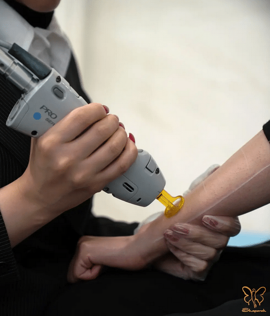 لیزر بیکینی